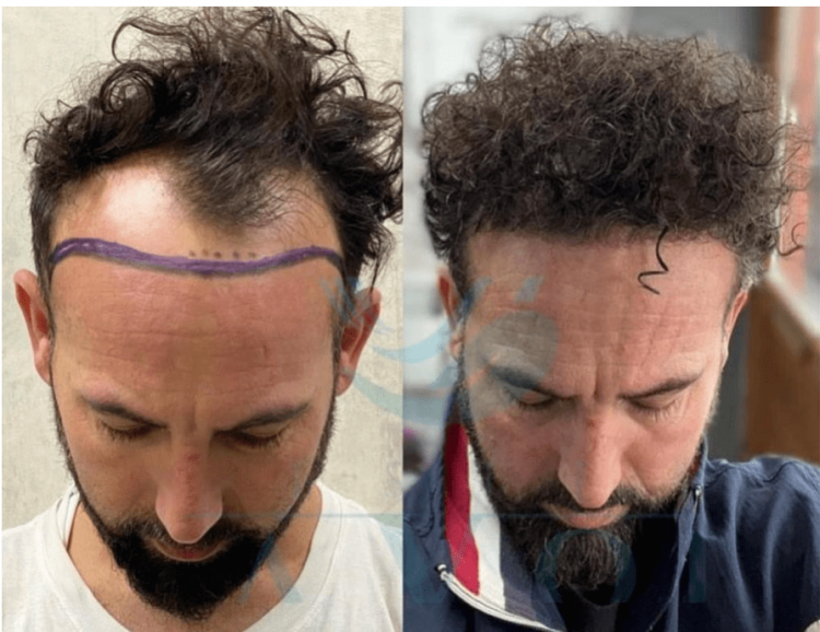 Este Favor Hair Transplant Result 